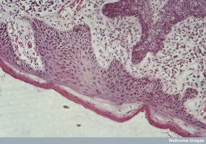 squamous cell carcinoma of the vulva