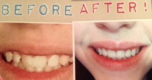 Teeth before and after orthodontic treatment