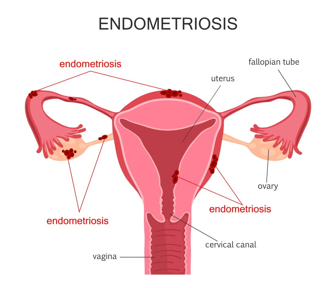 research on endometriosis